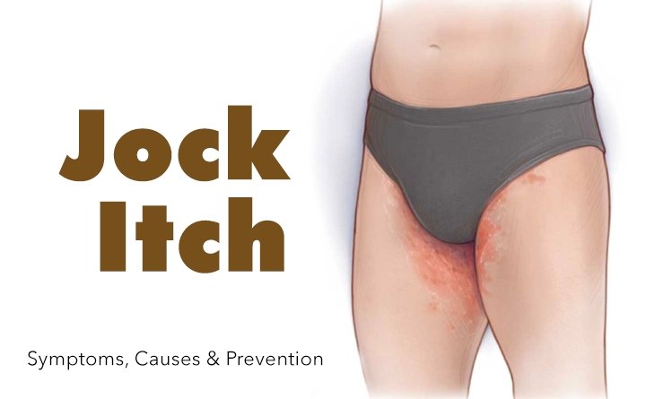 Jock itch: Is your underwear too tight?